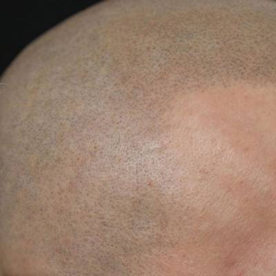 mikropigmentacja skóry głowy 