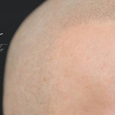 mikropigmentacja skóry głowy efekt