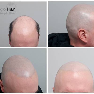 mikropigmentacja skóry głowy przed i po