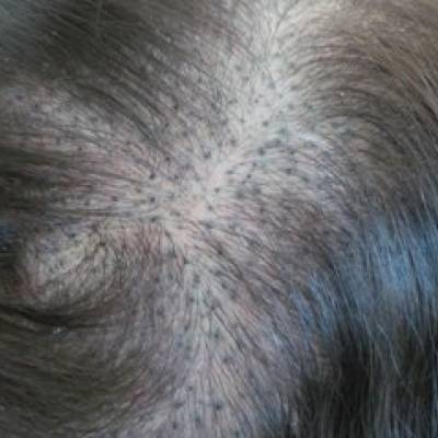 nieudana mikropigmentacja skóry głowy
