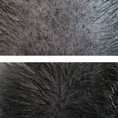 Zagęszczanie włosów mikropigmentacja skóry głowy efekty