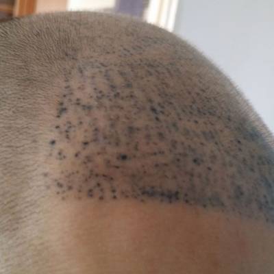 nieudana mikropigmentacja skóry głowy