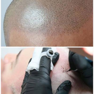 mikropigmentacja skóry głowy zabieg
