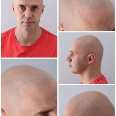 mikropigmentacja skóry głowy efekt